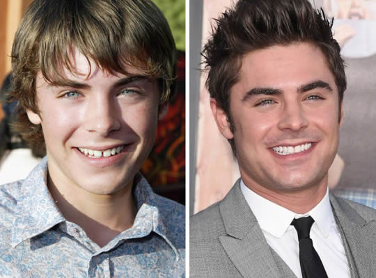 10 fotos do antes e depois do sorriso de celebridades