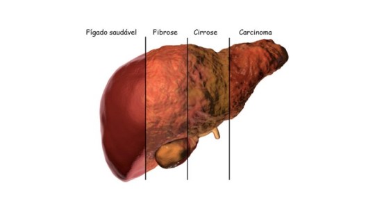10 informações importantes sobre esteatose hepática